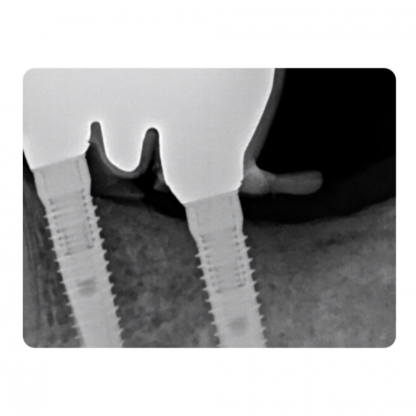Implantlink semi Xray cementas implantams, DETAX, 5 ml (2)